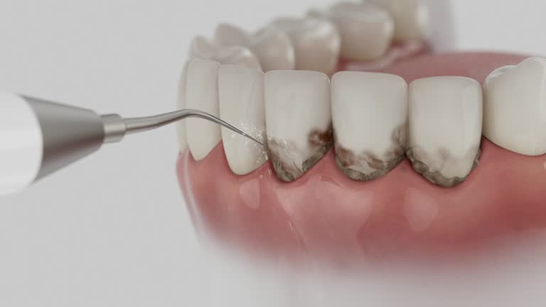 Trusted Wisdom Tooth Removal service in Chester, IL - Dentist Open Now